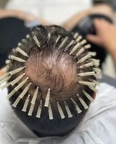 pdo hair restoration